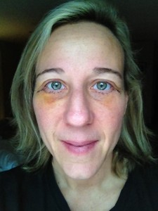 Day 10 after eye surgery